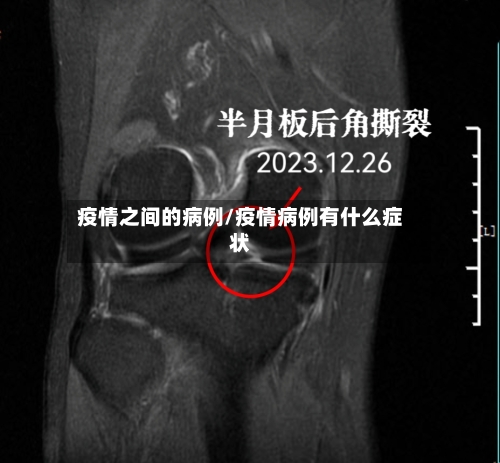 疫情之间的病例/疫情病例有什么症状-第2张图片