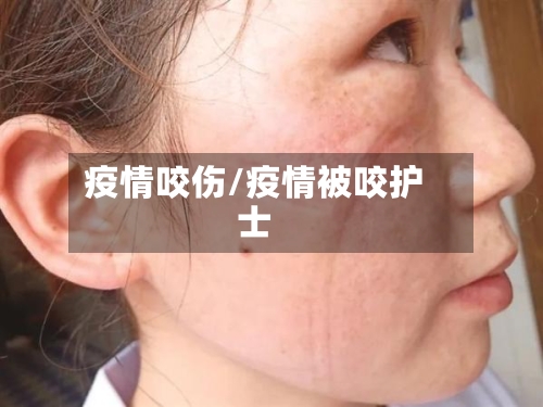 疫情咬伤/疫情被咬护士